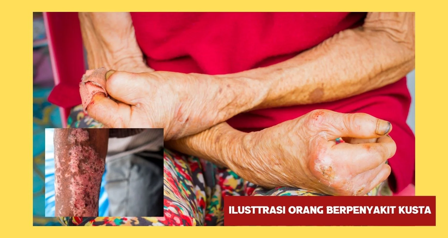 ilustrasi orang yang berpenyakit kusta