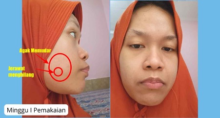 minggu kesatu pemakaian produk skintific moisturizer